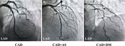 Nϵ-Carboxymethyl-Lysine Deteriorates Vascular Calcification in Diabetic Atherosclerosis Induced by Vascular Smooth Muscle Cell-Derived Foam Cells